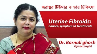 জরায়ুর টিউমার ও তার চিকিৎসা  Uterine Fibroids Causes symptoms and treatments by Barnali ghosh [upl. by Lynsey68]