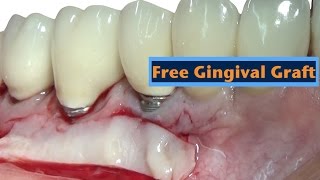 free gingival graft [upl. by Nitsyrc]