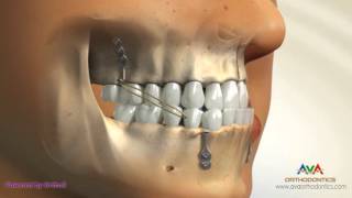 Orthodontic Treatment for Underbite or Crossbite  Bone Anchored Maxillary Protraction [upl. by Giesser]