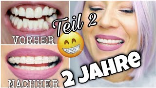 FESTE ZAHNSPANGE ERWACHSENE nach 2 Jahren  UPDATE😱 Keramik Brackets Erwachsene BRACES WithKat [upl. by Maia]