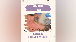 BBL Hero  Halo Sciton laser treatment combo up close progress photos and results included [upl. by Anyr]