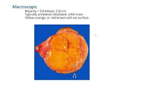 Leydig cell tumorGYNpath [upl. by Radley]