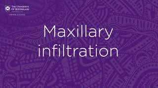 Dental local anaesthetics Maxillary infiltration [upl. by Atelra]