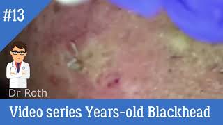 13 Video series Years old Blackhead Facial [upl. by Anitnamaid316]