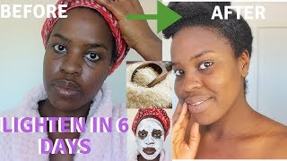 How I How i BRIGHTENED MY SKIN IN 6 DAYS REALISTIC and Natural way to reduce hyperpigmentation [upl. by Eimaraj]