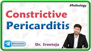 2 Constrictive Pericarditis  Pathology USMLE Step 1 [upl. by Raynah794]