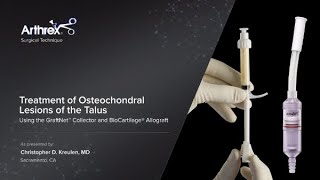 Treatment of Osteochondral Lesions of the Talus Using the GraftNet™ Collector and BioCartilage® Allo [upl. by Goodyear]