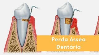 Perda óssea Dentária [upl. by Orit]