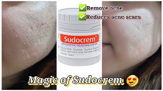 Sudocrem for acne  How to use sudocrem amp its benefits  One skincare solution [upl. by Yeclehc992]