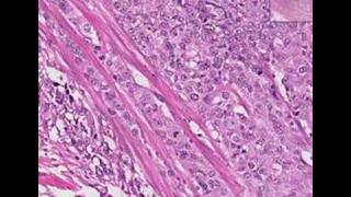 Histopathology Urinary bladderTransitional cell carcinoma [upl. by Egnalos]