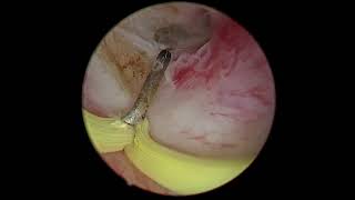 Ureteric Orifice incision for removal of UVJ impacted calculus Dr Aditya Sharma [upl. by Pearse198]