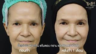 Sculptra VS Radiesse ต่างกันอย่างไร [upl. by Mayram]