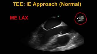 Transesophageal Echocardiography Infective Endocarditis [upl. by Gradey513]