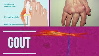 GOUT  Podagra  stages  pathophysiology clinical symptoms diagnosis  management [upl. by Etsirhc77]