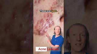 Acne Lesions White Heads Black heads Pustules Papules Cysts amp Nodules [upl. by Anavlys]