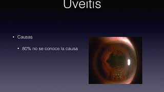 Uveitis en oftalmologia [upl. by Irehc]