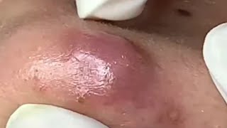 Blackheads Removal  Acne Treatment and Very Satisfying Satisfying Pimple pop blackheads [upl. by Woolson]