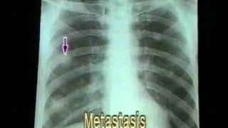 31 Bronchogenic Carcinoma  Chest XRays  Dr Vaidya [upl. by Fante]