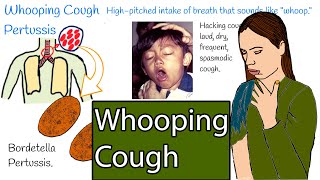 Whooping cough  Pertussis Hacking cough Symptoms and treatment [upl. by Galan732]