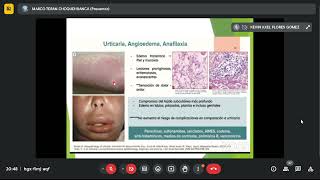 Dermatología Urticaria angioedema sd Stevens Johnson Necrósis epidermoide tóxica TUMORES2106 [upl. by Eeluj]