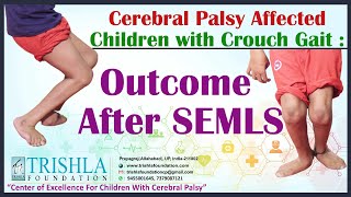 Cerebral Palsy Affected Children with Crouch Gait  Outcome After SEMLS  Trishla Foundation [upl. by Pappano]