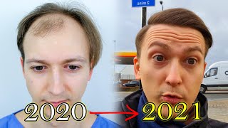 FUE Hair Transplant Growth Timeline  Before amp After [upl. by Relyks555]