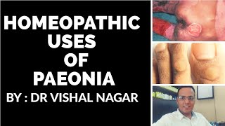 Homeopathic medicine PAEONIA for piles fistula fissure corns bunion and bed sores by Dr Vishal [upl. by Stedmann]