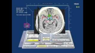 Virtual Reality planning of skull base surgery Tuberculum sellae meningioma [upl. by Dranoc]