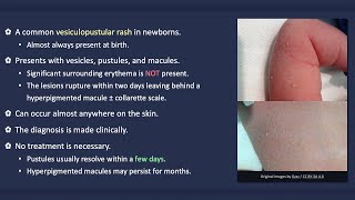 Transient Neonatal Pustular Melanosis [upl. by Renrut409]