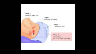 Bedsores Pressure Injuries Symptoms and Causes  Diagnosis  Treatment  Prevention health [upl. by Ahsilla]