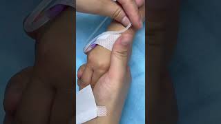 Acupuncture routine outpatient work is a technical job acupuncture VEIN shorts [upl. by Enoed]