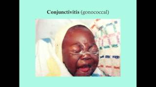 Conjunctivitis  CRASH Medical Review Series [upl. by Seigler137]