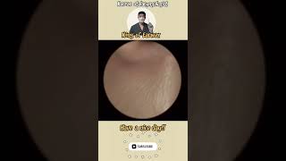 귀지형 콧물 부비동염 축농증 비염 코청소 이비인후과 rhinorrhea rhinitis sinusitis asmr ENT entdoctor [upl. by Endora]