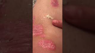 1st psoriasis peel [upl. by Lachman86]