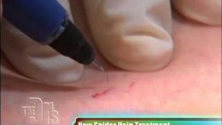 Spider Vein Treatment The Doctors [upl. by Burford]