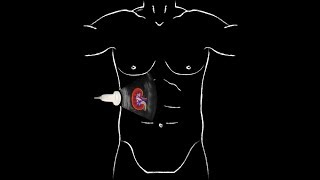 POCUS  Basic Renal Ultrasound [upl. by Hsara]