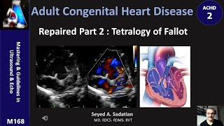 ACHD 2 Repaired Part 2  Tetralogy of Fallot [upl. by Gilbye]