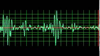 Infective Endocarditis Mitral Regurgitation slow [upl. by Leitman]