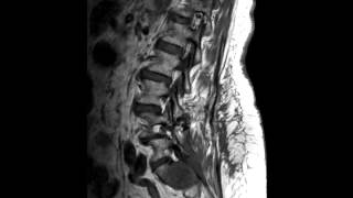 Myxopapillary Ependymoma [upl. by Ohcirej]