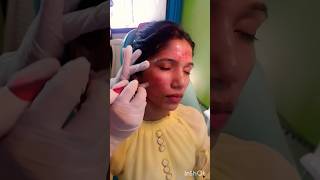 prp treatmentshort shortsfeed ytshorts youtubeshorts prptreatment skincare skin [upl. by Notlaw462]