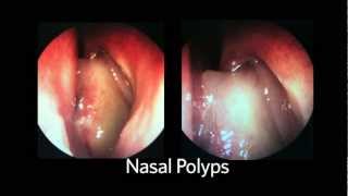 AAOHNSF The ENT Exam Episode 4 The Nasopharynx and Larynx Exam [upl. by Assilaj]