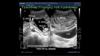 Twin molar pregnancy with Fetal demise [upl. by Meredithe]