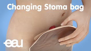 Changing stoma bag after bladder cancer treatment [upl. by Anohs]