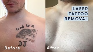 Laser Tattoo Removal  Before and After through all the stages [upl. by Torrin732]