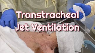 Transtracheal Jet Ventilation in a Cadaver Model [upl. by Fidela220]