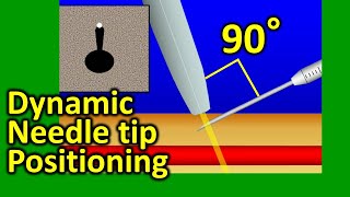 Ultrasound guided dynamic needle tip positioning in peripheral vein and artery cannulation [upl. by Uund]