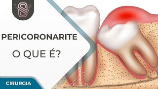 Pericoronarite  Cirurgia oral [upl. by Petunia]