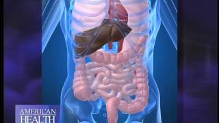 What is Diverticulitis Video [upl. by Zashin]