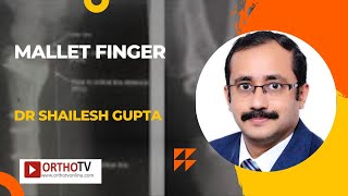 Mallet Finger by Dr Shailesh Gupta [upl. by Sarette415]