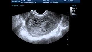 early pregnancy bleedingquot abortion  ectopic pregnancyquot [upl. by Einafats]